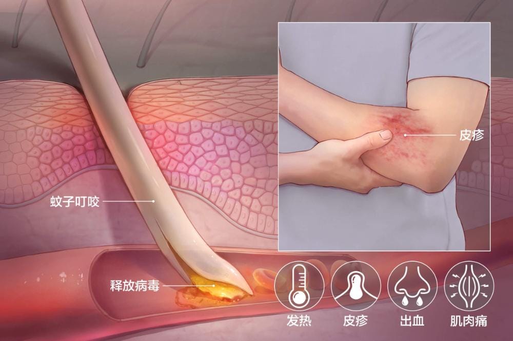 人参贝母茶运用于感染”登革热病毒“效果极好
